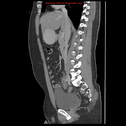 File:Acute appendicitis (Radiopaedia 10498-10973 Sagittal C+ portal venous phase 23).jpg