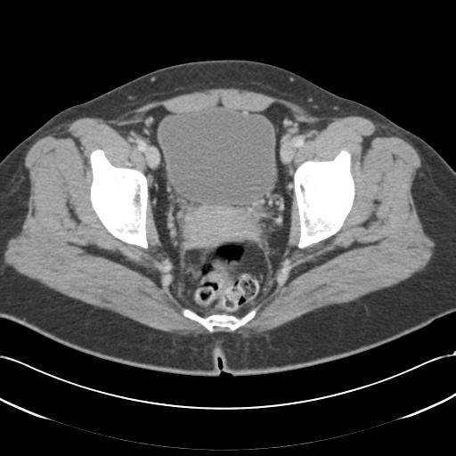 Acute appendicitis (Radiopaedia 30297-30934 Axial C+ portal venous phase 74).jpg