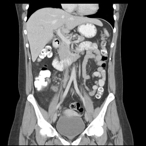 Acute appendicitis (Radiopaedia 30297-30934 Coronal C+ portal venous phase 21).jpg