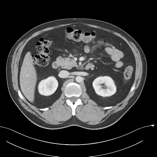 Acute appendicitis (Radiopaedia 36611-38177 Axial C+ portal venous phase 37).png