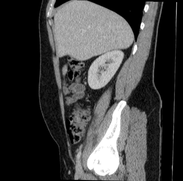 Acute appendicitis (Radiopaedia 38255-40270 Sagittal C+ portal venous phase 24).jpg