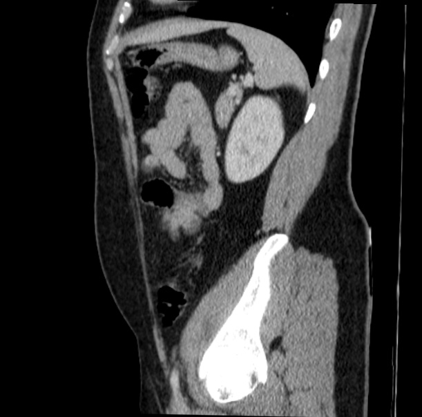 Acute appendicitis (Radiopaedia 38255-40270 Sagittal C+ portal venous phase 62).jpg