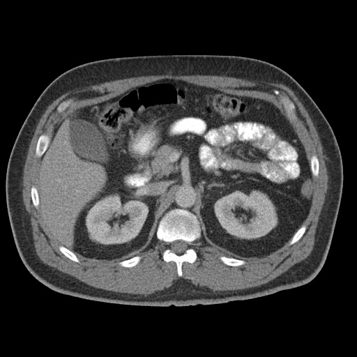 Acute appendicitis (Radiopaedia 48511-53463 Axial C+ portal venous phase 35).jpg