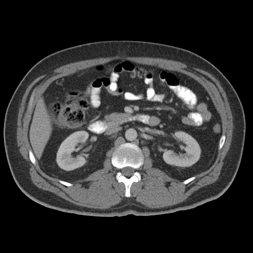 Acute appendicitis (Radiopaedia 48511-53463 Axial C+ portal venous phase 42).jpg