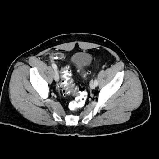Acute appendicitis (Radiopaedia 77016-88960 Axial C+ portal venous phase 120).jpg