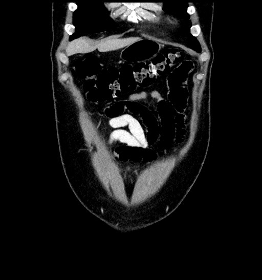 Acute appendicitis (Radiopaedia 77016-88960 Coronal C+ portal venous phase 24).jpg
