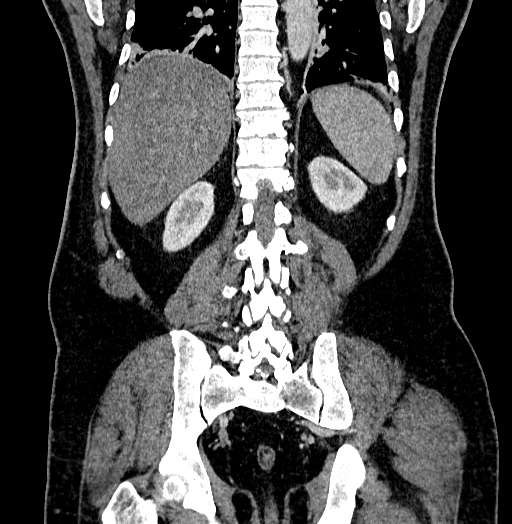 Acute appendicitis (Radiopaedia 79950-93224 Coronal C+ portal venous phase 70).jpg