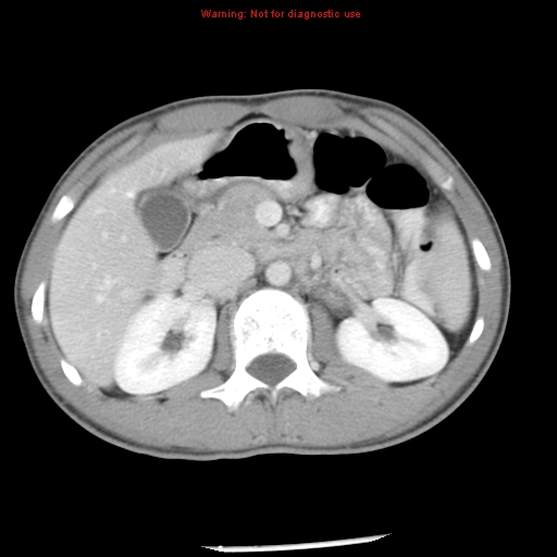 Acute appendicitis (Radiopaedia 8195-9045 Axial C+ portal venous phase 26).jpg