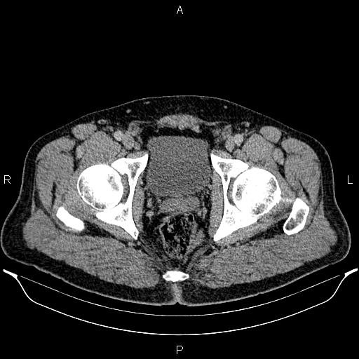 Acute appendicitis (Radiopaedia 84780-100240 Axial C+ portal venous phase 106).jpg