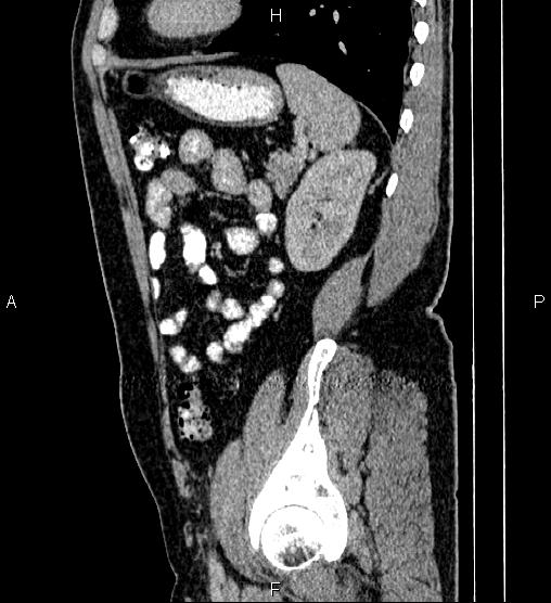 Acute appendicitis (Radiopaedia 84780-100240 Sagittal C+ portal venous phase 80).jpg