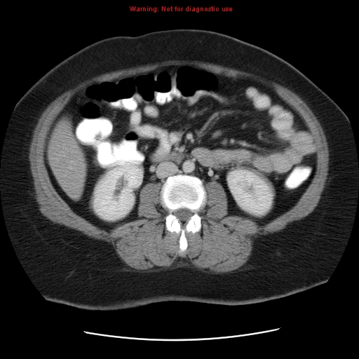Acute appendicitis complicated by ovarian vein thrombophlebitis (Radiopaedia 16172-15851 Axial C+ portal venous phase 48).jpg