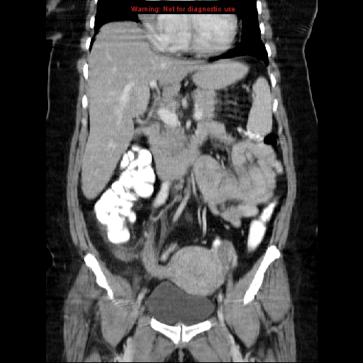 File:Acute appendicitis complicated by ovarian vein thrombophlebitis (Radiopaedia 16172-15851 Coronal C+ portal venous phase 38).jpg