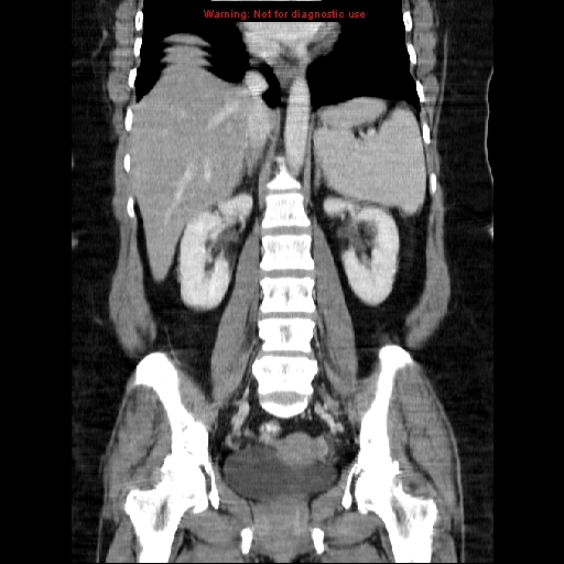 Acute appendicitis complicated by ovarian vein thrombophlebitis (Radiopaedia 16172-15851 Coronal C+ portal venous phase 51).jpg