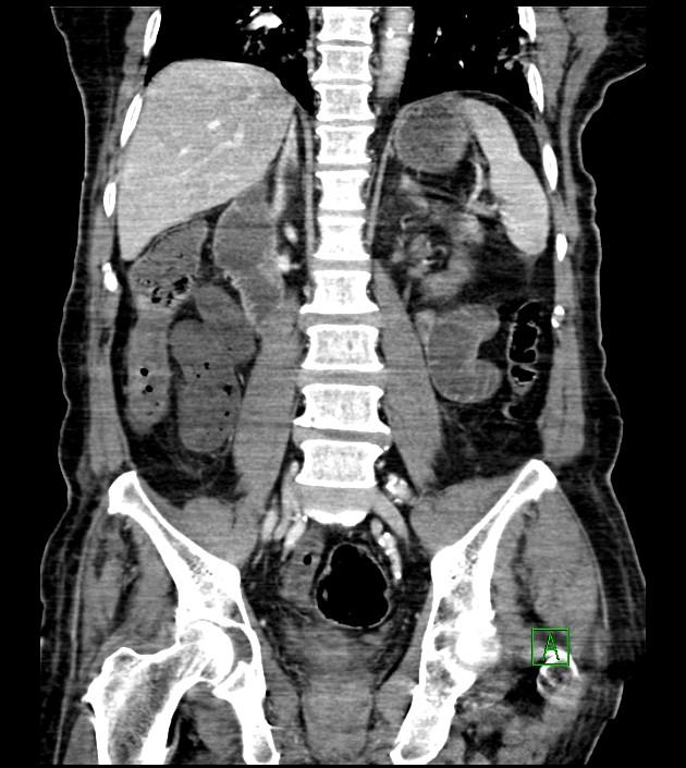 Acute arterial mesenteric ischemia (Radiopaedia 78238-90828 Coronal C+ portal venous phase 59).jpg