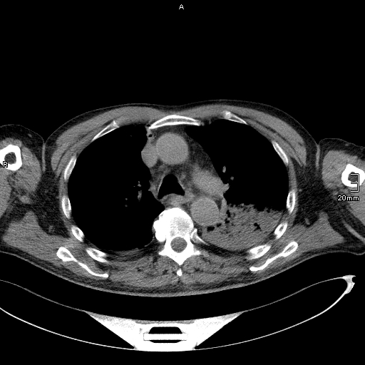Acute aspiration pneumonitis (Radiopaedia 55642-62166 Axial liver window 24).jpg