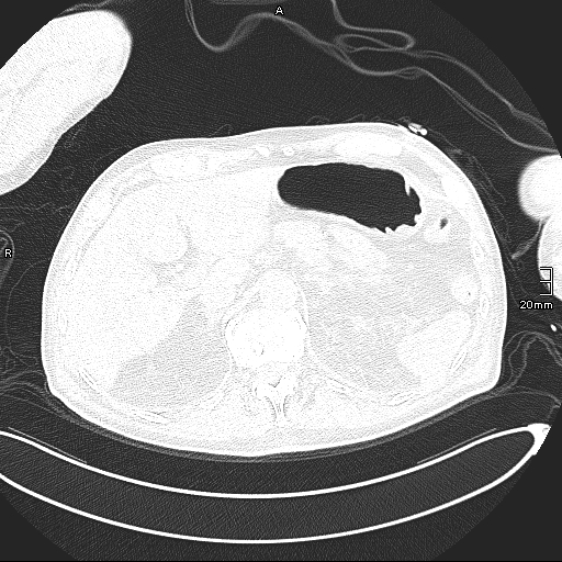 Acute aspiration pneumonitis (Radiopaedia 55642-62166 Axial lung window 152).jpg