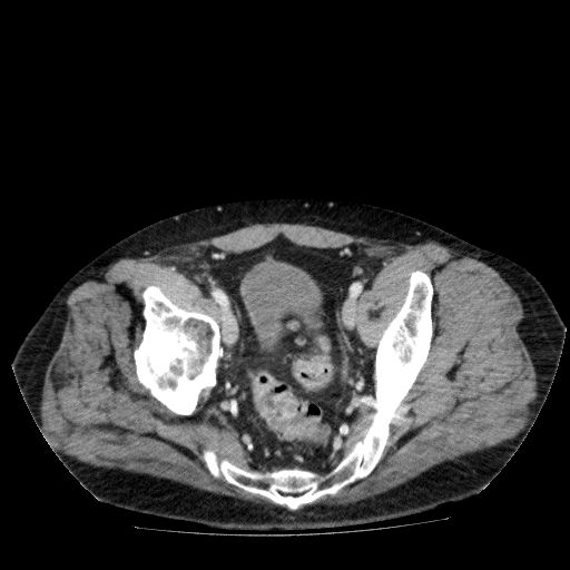 Acute cholecystitis and incidental left sided IVC (Radiopaedia 49352-54459 Axial C+ portal venous phase 134).jpg