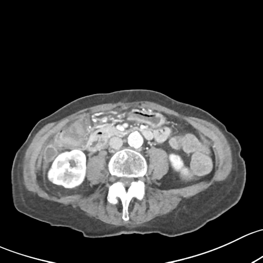 File:Acute cholecystitis with contained perforation (Radiopaedia 47328-51907 Axial C+ portal venous phase 38).png