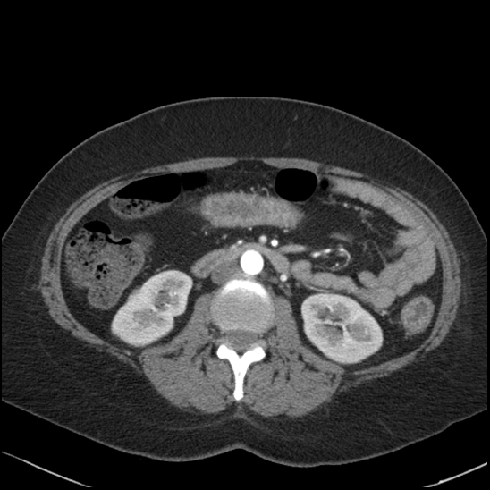 Acute colonic hemorrhage in ulcerative colitis (Radiopaedia 77415-89538 Axial C+ arterial phase 60).jpg