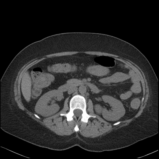 Acute colonic hemorrhage in ulcerative colitis (Radiopaedia 77415-89538 Axial non-contrast 55).jpg