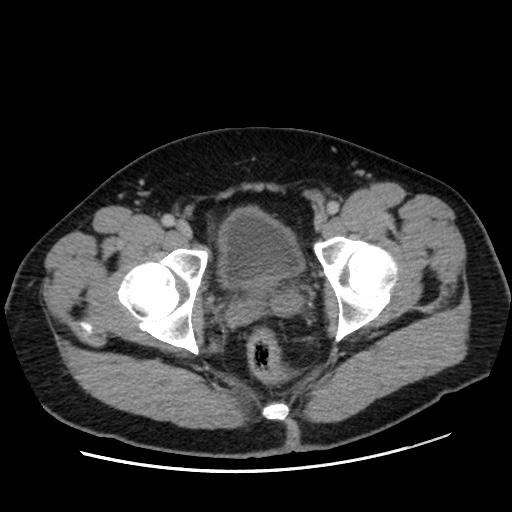 Acute diverticulitis with localized perforation (Radiopaedia 41296-44113 Axial C+ portal venous phase 86).jpg