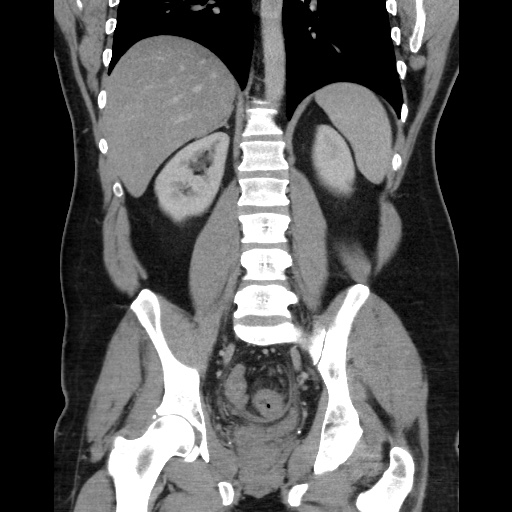 File:Acute diverticulitis with localized perforation (Radiopaedia 41296-44113 Coronal C+ portal venous phase 42).jpg