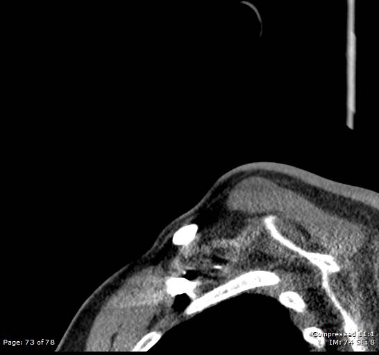 Acute epiglottitis (Radiopaedia 54375-60590 Sagittal C+ arterial phase 73).jpg