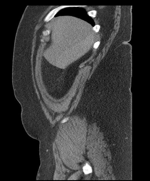Acute mesenteric venous ischemia (Radiopaedia 46041-50383 Sagittal C+ portal venous phase 13).jpg