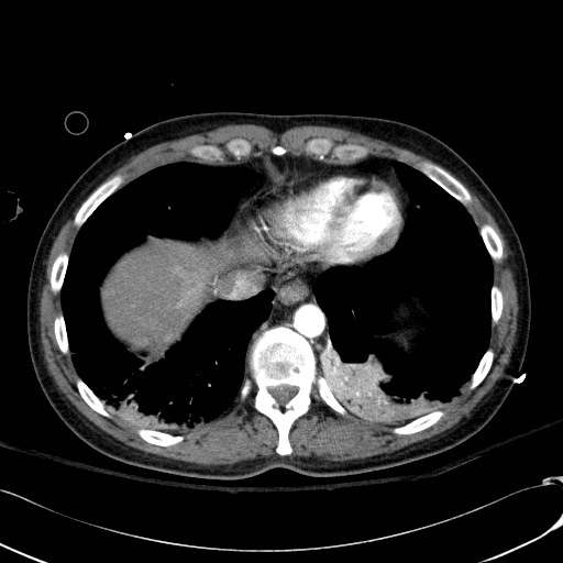Acute myocardial infarction in CT (Radiopaedia 39947-42415 Axial C+ arterial phase 112).jpg