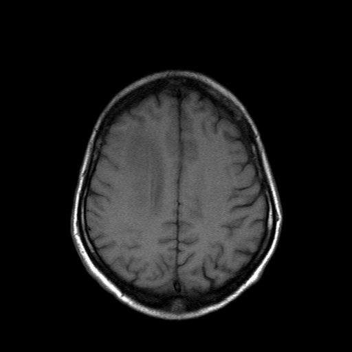 File:Acute necrotizing toxoplasma encephalitis (Radiopaedia 10683-11149 Axial T1 5).jpg