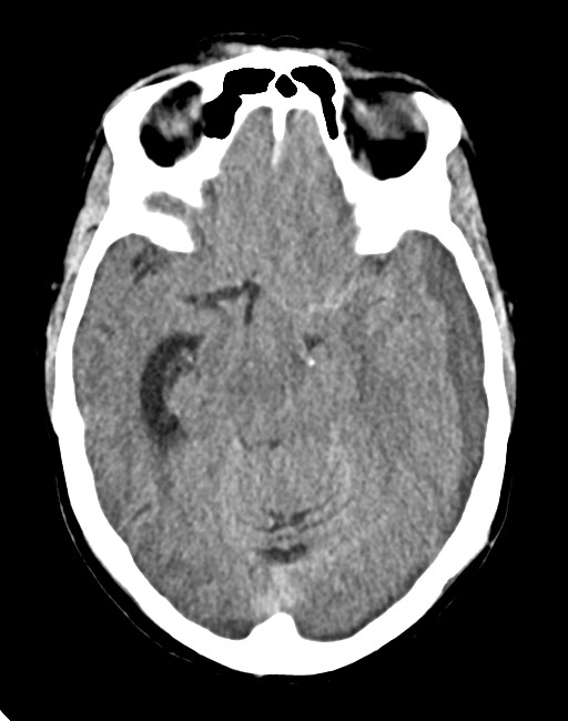Acute on chronic subdural hematoma (Radiopaedia 74814-85823 Axial non-contrast 40).jpg
