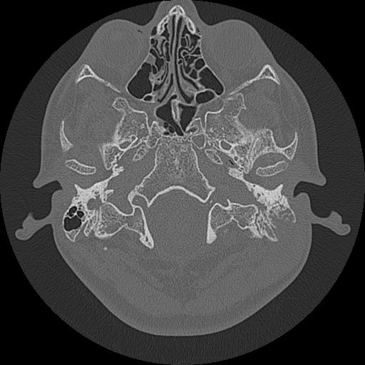 Acute otomastoiditis and Bezold abscess (Radiopaedia 88184-104786 Axial bone window 18).jpg