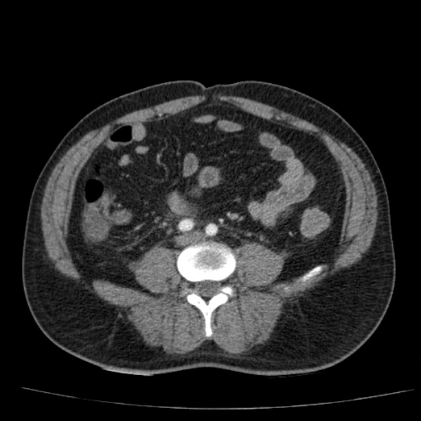 Acute pancreatitis (Radiopaedia 26663-26813 Axial C+ arterial phase 64).jpg