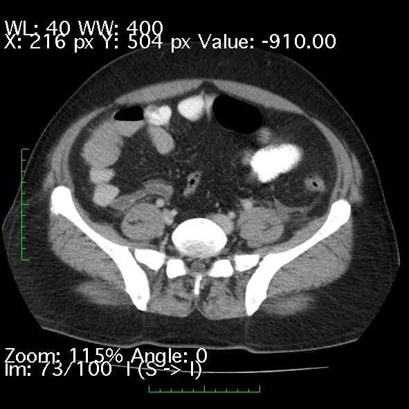 Acute pancreatitis (Radiopaedia 34043-35276 Axial C+ portal venous phase 73).jpg