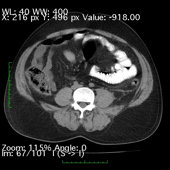 Acute pancreatitis (Radiopaedia 34043-35276 Axial non-contrast 67).jpg
