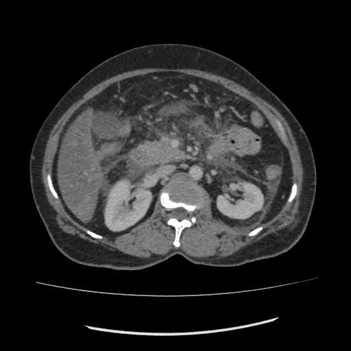 Acute pancreatitis (Radiopaedia 80007-93285 Axial C+ portal venous phase 73).jpg