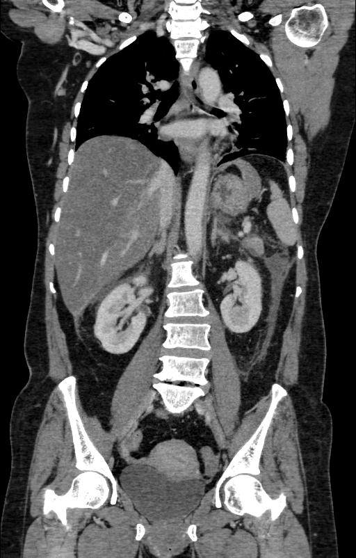 Acute pancreatitis (Radiopaedia 80007-93285 Coronal C+ portal venous phase 82).jpg