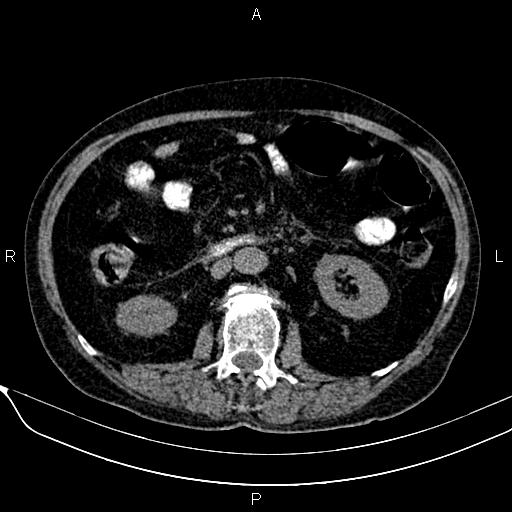 File:Acute pancreatitis (Radiopaedia 85146-100701 Axial non-contrast 60).jpg