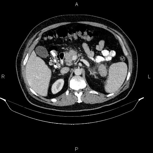File:Acute pancreatitis (Radiopaedia 85390-101010 Axial C+ portal venous phase 35).jpg