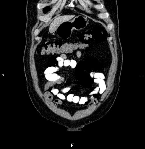 Acute pancreatitis (Radiopaedia 85390-101010 Coronal C+ portal venous phase 6).jpg