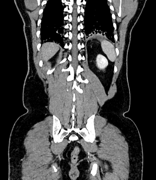 File:Acute pancreatitis (Radiopaedia 87428-103757 Coronal C+ portal venous phase 76).jpg