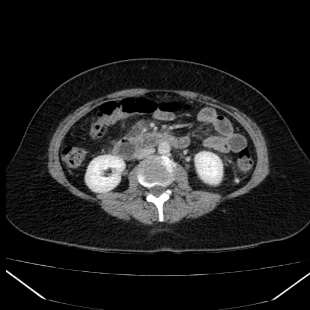 Acute pancreatitis - Balthazar C (Radiopaedia 26569-26714 Axial C+ portal venous phase 50).jpg