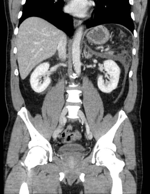 Acute pancreatitis - Balthazar E (Radiopaedia 23080-23110 Coronal C+ portal venous phase 47).jpg
