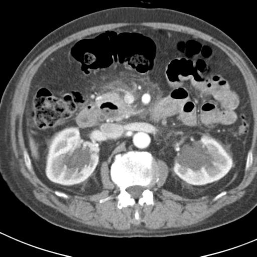 File:Acute pancreatitis and walled-off necrosis (Radiopaedia 29888-30403 Axial C+ portal venous phase 20).jpg