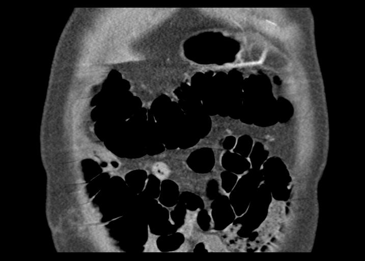 Acute pancreatitis and walled-off necrosis (Radiopaedia 29888-30403 Coronal C+ portal venous phase 11).jpg