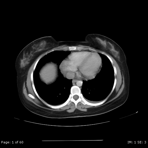 File:Acute pancreatitis with acute fluid collection "phlegmon" (Radiopaedia 27351).jpg