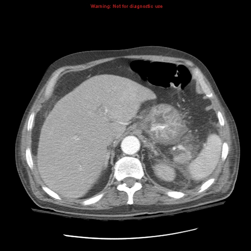 File:Acute pancreatitis with incidental pancreatic lipoma (Radiopaedia 10190-10730 Axial C+ arterial phase 25).jpg