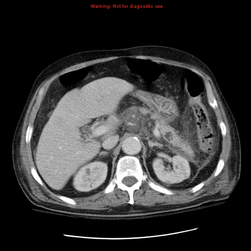File:Acute pancreatitis with incidental pancreatic lipoma (Radiopaedia 10190-10730 Axial C+ portal venous phase 20).jpg