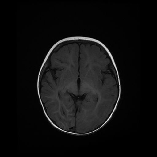 File:Acute phase of hemiconvulsion-hemiplegia epilepsy syndrome (Radiopaedia 29309-29745 Axial T1 13).jpg
