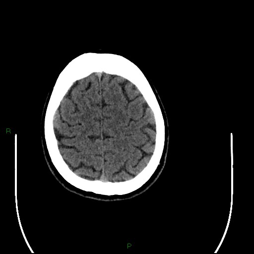 File:Acute posterior cerebral artery territory infarct (Radiopaedia 79329-92393 Axial non-contrast 92).jpg